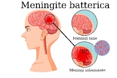 Meningite