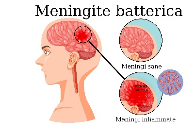 Meningite