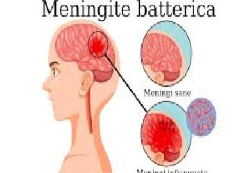 Meningite meningococcica