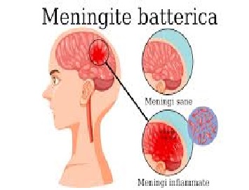 Meningite meningococcica